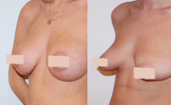 Augmentation mammaire Genève