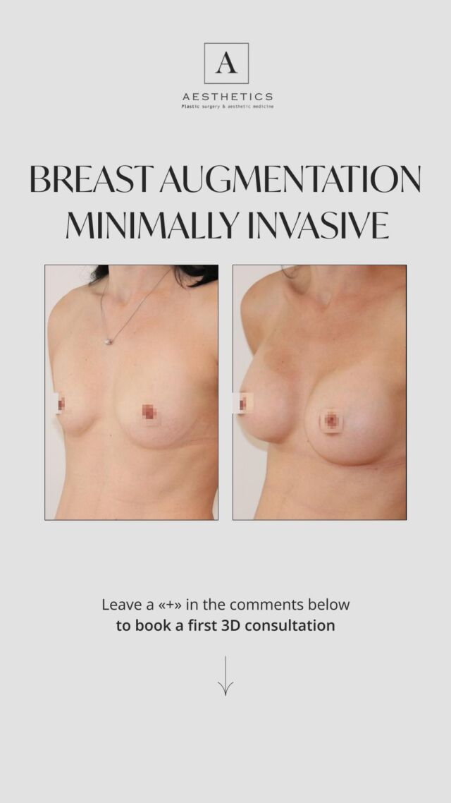 ✨ From Insecurity to Empowerment—A Transformation in 30 Minutes ✨

For years, our patient struggled with feeling self-conscious about her small breasts. Clothes didn’t fit right, swimsuits were a source of discomfort, and no matter what she tried, she couldn’t find the confidence she was searching for. The fear of unnatural results and long recovery times held her back. 🖤🤍

Then, everything changed after one consultation. 🖤

She trusted our expert team and chose minimally invasive breast augmentation. In just 30 minutes, our surgeons carefully placed 350cc implants, sculpting a natural, elegant shape that enhanced her confidence—without the long recovery she feared. 🤍

Now, she embraces life with renewed confidence, free from insecurities—just pure self-love and empowerment every day. 🖤

💌 Ready for your own transformation?

You can sign up for a consultation in BIO @aesthetics_clinic_geneva
Connect with us:
📍Geneva: Call +41 22 732 22 23 or WhatsApp at +41 79 931 20 66
📍Montreux: Call +41 79 908 98 98
📍Gstaad: Call +41 79 196 98 69

#BreastAugmentationGENEVA #AugmentationMammaireGenève #MinimallyInvasiveBreastAugmentationGENEVA #BreastLiftGENEVA #BreastImplantsGENEVA #NaturalBreastAugmentation #BreastEnhancementGENEVA #PlasticSurgeryGeneva #MastopexyGENEVA #FatTransferBreastAugmentationGENEVA #ImplantsMammairesGenève #AugmentationSeinsGenève #LiftingMammaireGenève #AugmentationMammaireMinimaleGenève #ChirurgieEsthétiqueGenève #ChirurgieMammaireGenève #LipofillingSeinsGenève #MastopexieGenève#augmentationmammairegeneve#drtenorio 
#aestheticsclinic