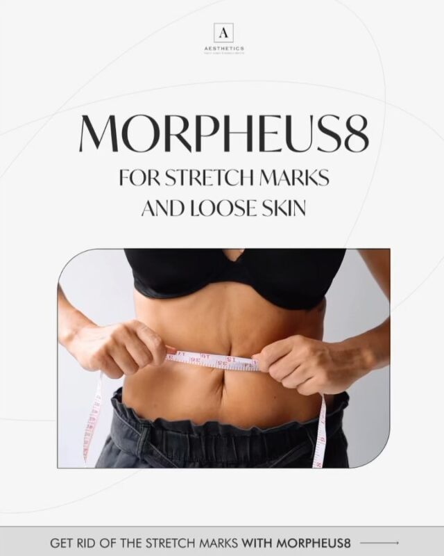 Stretch Marks? Not Anymore! 💥

You deserve skin that makes you feel confident! ✨ Morpheus8 is a game-changer—it smooths stretch marks, tightens loose skin, and restores elasticity!

💎 Why does it work?
🔥 Deep skin renewal from within
💖 Boosts powerful collagen production
⚡ Reduces the appearance of stretch marks after just a few sessions

💃 Ready to say goodbye to stretch marks and sagging skin? Check out our highlights for an 🔥 exclusive special offer you won’t want to miss! 💕

#BodyContouringGenève #RFGenève
#MorpheusGenève #DermomaskGenève
#FatLossGenève #SlimmingGenève
#BodySculptingGenève #NonSurgicalContour
#SkinTighteningGenève #FatReductionGenève
#BeautyTreatmentsGenève
#CelluliteTreatmentGenève #StretchMarksGenève
#StretchMarksTreatmentGenève
#StretchMarksRemovalGenève
#FlawlessSkinGenève#drtenorio
#aestheticsclinic