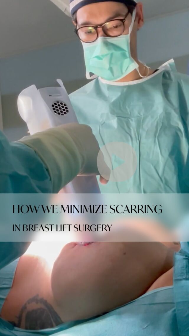 We understand your concerns about post-surgery scarring. 🤍

Our expert surgeons use advanced techniques to minimize visible marks. Through strategic incision placement along nipples and our specialized multi-layered suturing approach, we ensure optimal healing with minimal scarring. 🤍

We're committed to transparency - that's why we want to show you exactly how our careful surgical approach works. From precise incision planning to post-operative care with URGO technology, every step is designed to give you the best possible aesthetic outcome. ⚫

Ready to learn more about breast lift surgery and our advanced scarring minimization techniques? Schedule a consultation today or follow us for expert insights into aesthetic procedures. DM us with your questions! 🤍

You can sign up for a consultation in BIO @aesthetics_clinic_geneva
Connect with us:
📍Geneva: Call +41 22 732 22 23 or WhatsApp at +41
79 931 20 66
📍Montreux: Call +41 79 908 98 98
📍Gstaad: Call +41 79 196 98 69

#BreastAugmentationGENEVA#AugmentationMammaireGenève#MinimallyInvasiveBreastAugmentationGENEVA#BreastLiftGENEVA #BreastImplantsGENEVA#NaturalBreastAugmentation#BreastEnhancementGENEVA #PlasticSurgeryGeneva#MastopexyGENEVA #FatTransferBreastAugmentationGENEVA#ImplantsMammairesGenève #AugmentationSeinsGenève#LiftingMammaireGenève #AugmentationMammaireMinimaleGenève #ChirurgieEsthétiqueGenève #ChirurgieMammaireGenève #LipofillingSeinsGenève#MastopexieGenève#drTenorio#aestheticsclinic